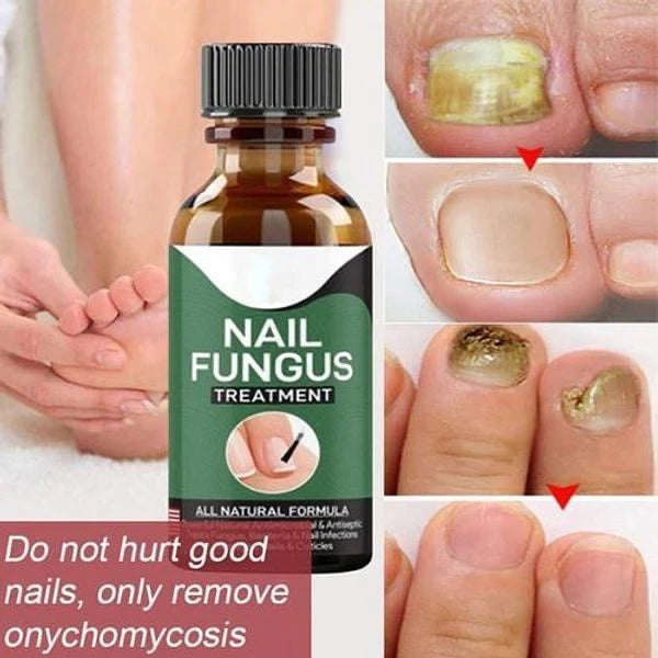 Fast Nail Fungal Treatments Nail Repair Serum Care