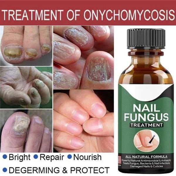 Fast Nail Fungal Treatments Nail Repair Serum Care